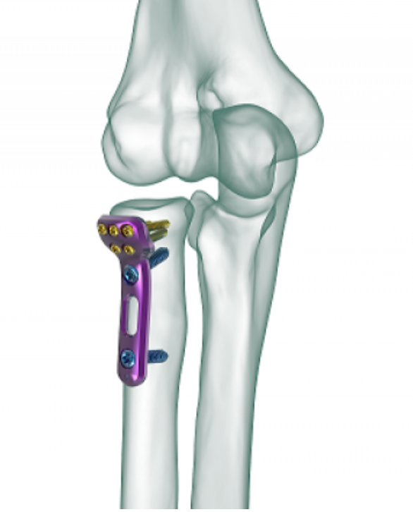 Distal Pylon Plate