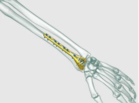 Distal Fibula Plaque