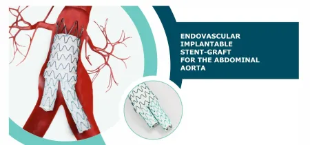 Endovascular Implantable Stent Graft