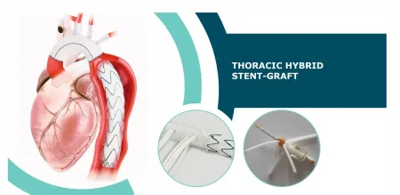 Thoracic Hybrid Stent Graft